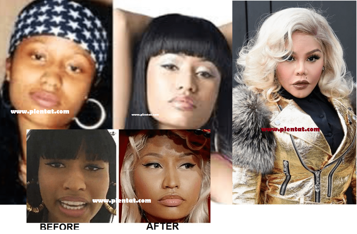 Nicki Minaj Before Plastic Surgery